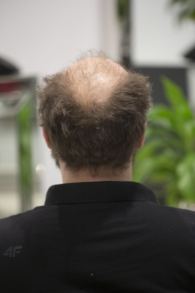 Efekt przed zabiegiem niechirurgicznego zagęszczania włosów w Salonie Fryzjerstwa Magdalena Motyka La Coiffure Płock. Klient zyska pełniejsze i bardziej dynamiczne włosy, uzyskane dzięki zaawansowanym technikom i profesjonalnej obsłudze.